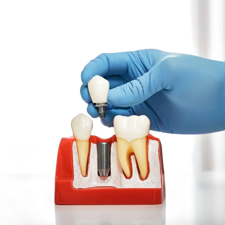 Implant Dentistry Toronto, ON