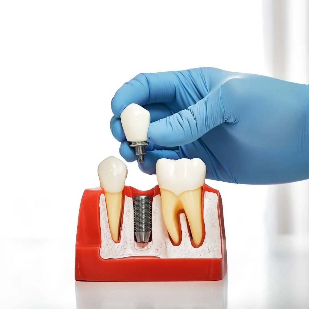 dental implants Toronto ON