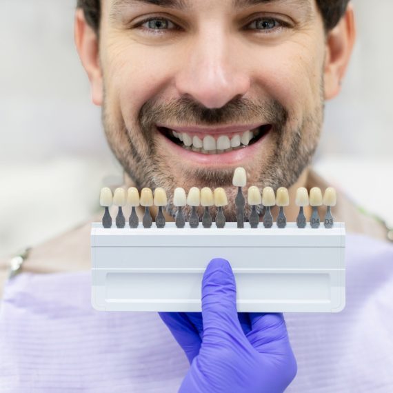 Veneers